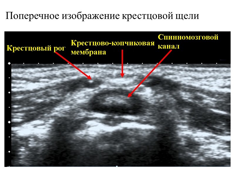 Поперечное изображение крестцовой щели